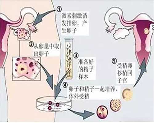 昆明男子精液异常泰国试管助孕生子